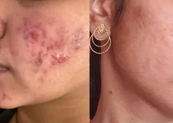Before after 1