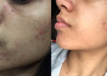 Before after 2