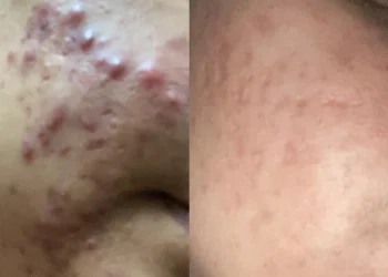 Before after 3