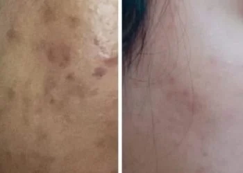 Before after 4