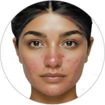 Damaged skin barrier