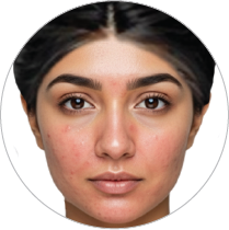 Redness/blemishes /Rosacea skin