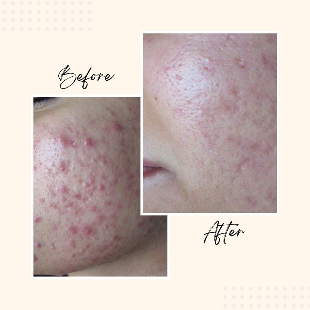 AZSE before after result