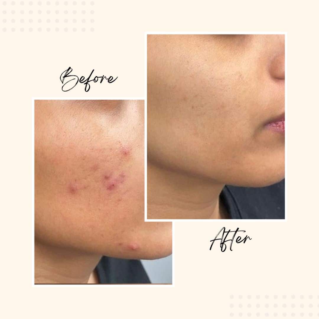 AZSE before after result